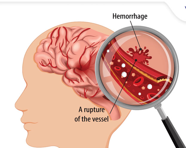 Brain Haemorrhage Treatment