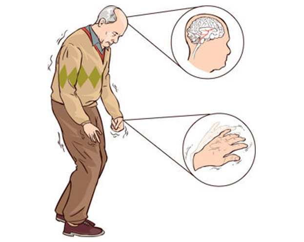 parkinsons-treatment